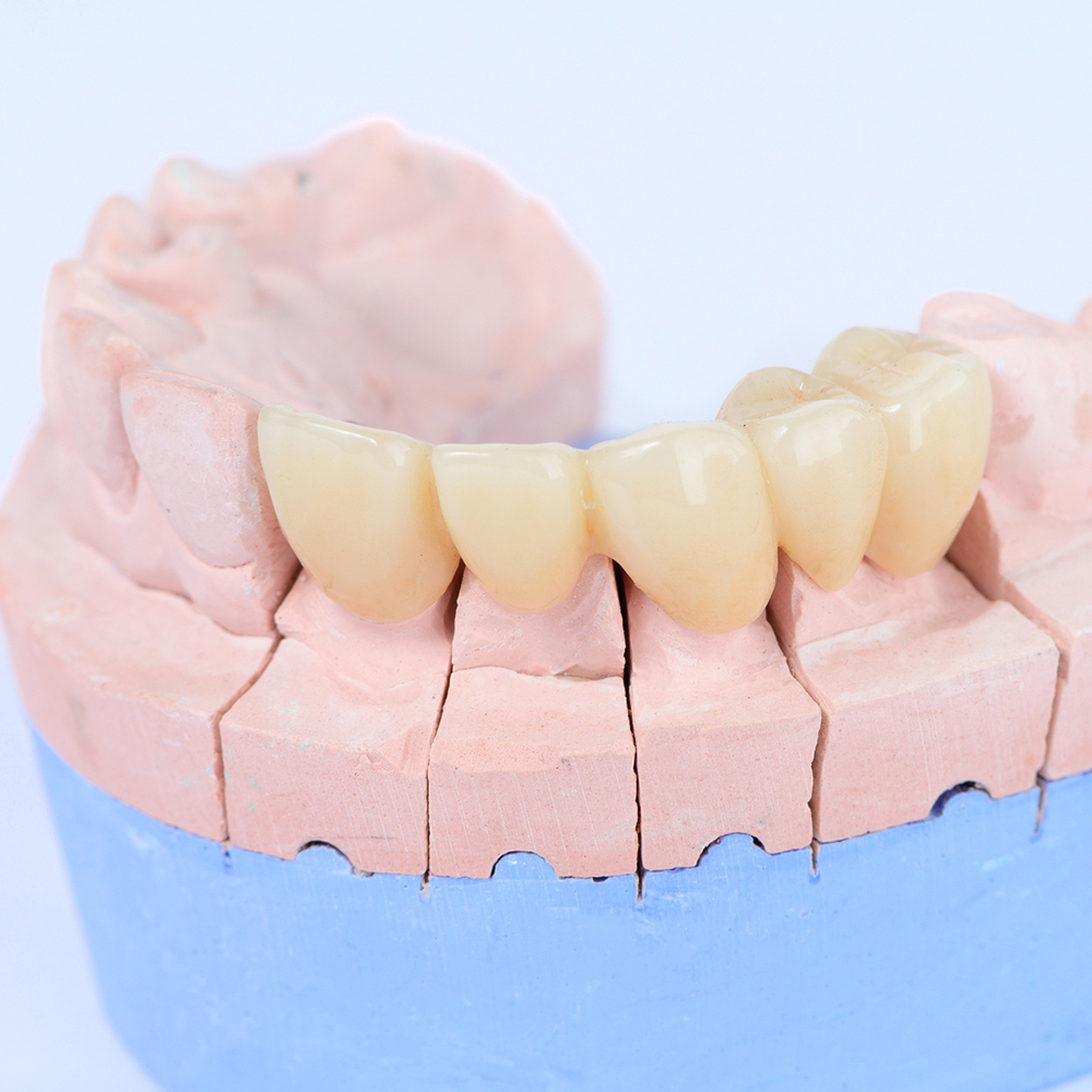 鹿児島市・鹿児島のメタルフリー治療
