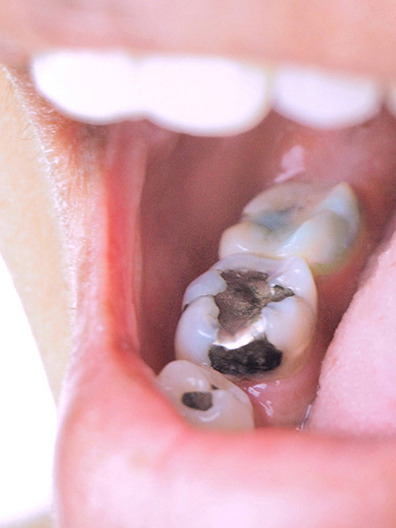 鹿児島市・鹿児島のメタルフリー治療