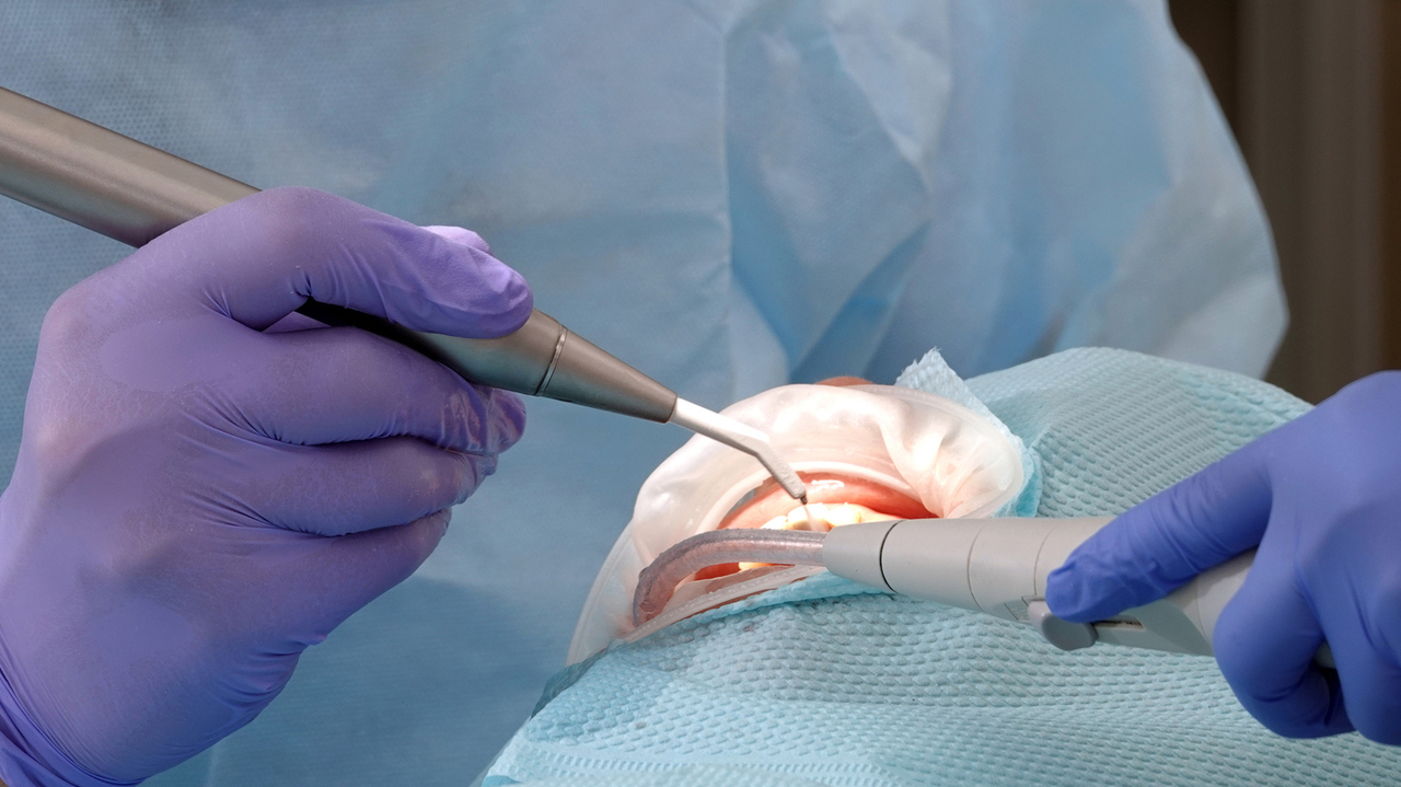 鹿児島市・鹿児島の炭酸ガスレーザー