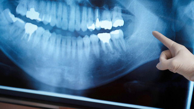 鹿児島市・鹿児島の歯科医院のなるべく神経を残す治療