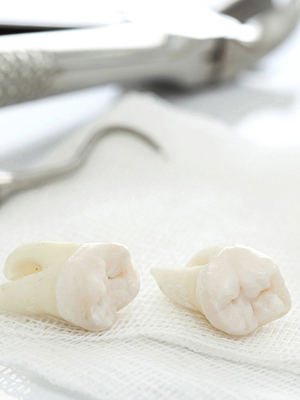 鹿児島市・鹿児島の親知らずの抜歯・治療