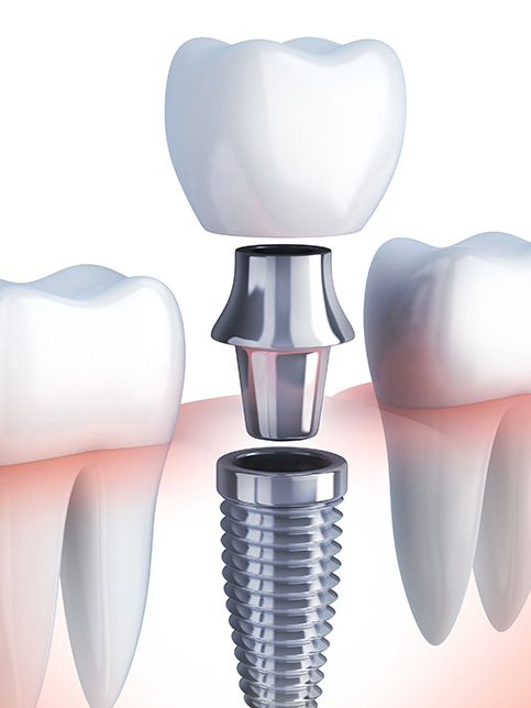 鹿児島市・鹿児島のインプラント治療