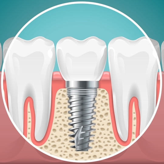 鹿児島市・鹿児島のインプラント治療