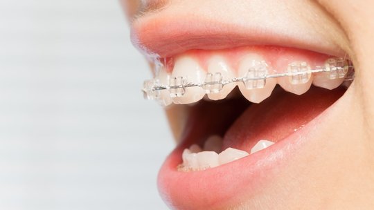 鹿児島市・鹿児島の矯正歯科治療