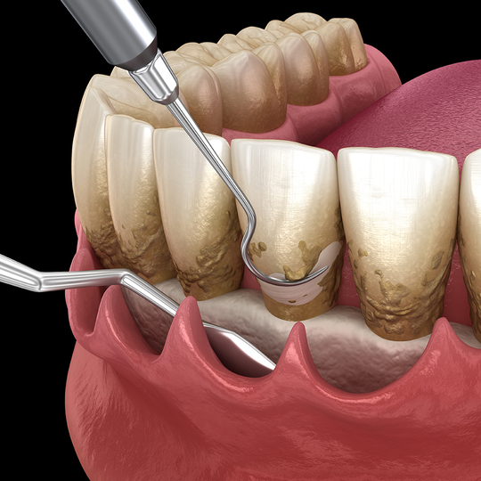 鹿児島市・鹿児島の歯周病の治療