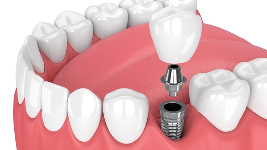 鹿児島市・鹿児島のインプラント治療