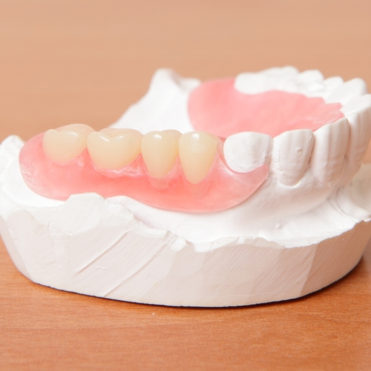 鹿児島市・鹿児島のノンクラスプデンチャー（目立たない部分入れ歯）