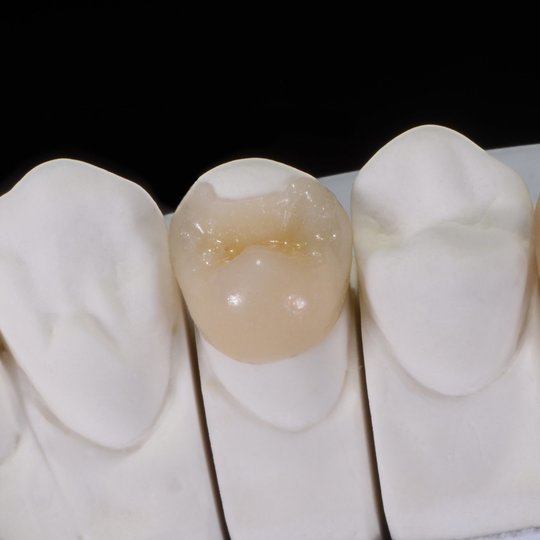 鹿児島市・鹿児島の虫歯治療