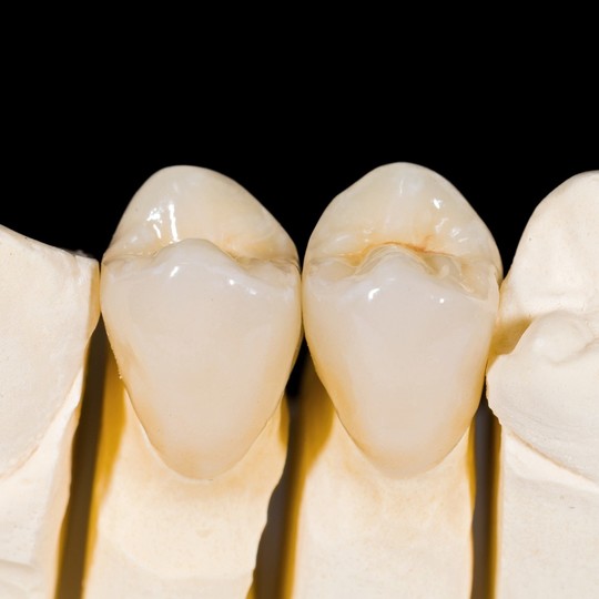 鹿児島市・鹿児島のセラミック治療