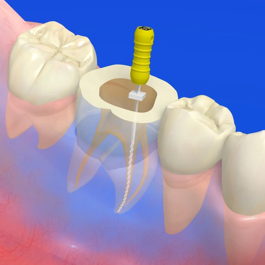鹿児島市・鹿児島の虫歯治療