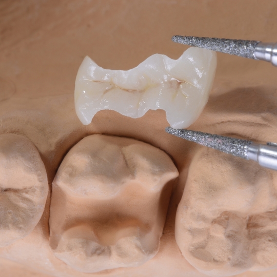 鹿児島市・鹿児島のセラミック治療