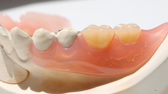 鹿児島市・鹿児島の自費の入れ歯・義歯治療