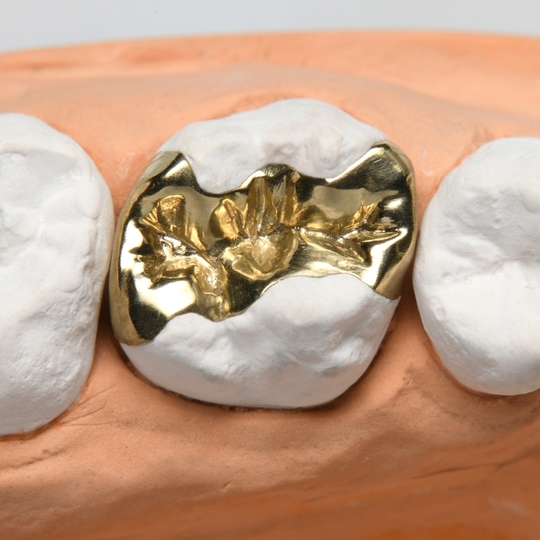 鹿児島市・鹿児島の審美歯科治療（白い詰め物・被せ物）