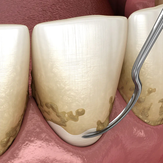 鹿児島市・鹿児島の歯周病の治療