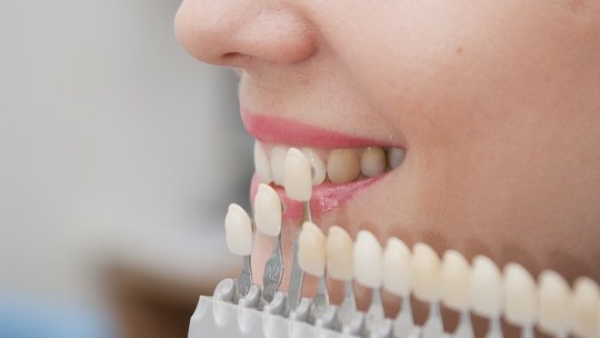 鹿児島市・鹿児島の審美歯科治療（白い詰め物・被せ物）