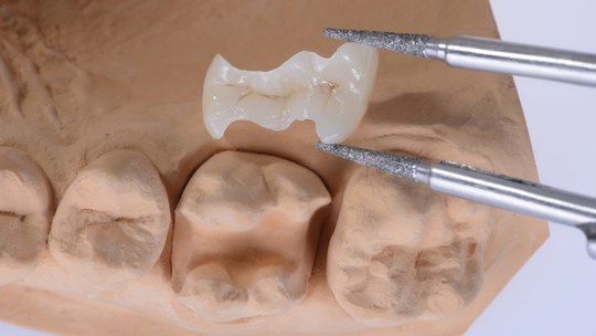 鹿児島市・鹿児島の審美歯科治療（白い詰め物・被せ物）