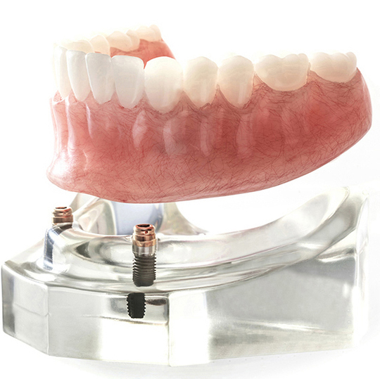 鹿児島市・鹿児島の自費の入れ歯・義歯治療