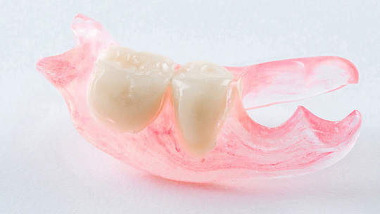 鹿児島市・鹿児島のノンクラスプデンチャー（目立たない部分入れ歯）