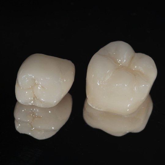 鹿児島市・鹿児島の審美歯科治療（白い詰め物・被せ物）