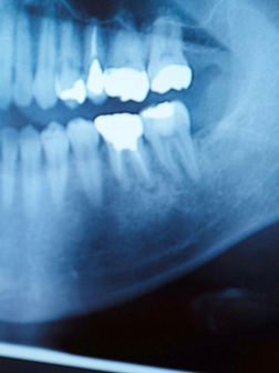 鹿児島市・鹿児島の歯周組織再生療法