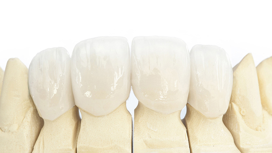 鹿児島市・鹿児島のセラミック治療