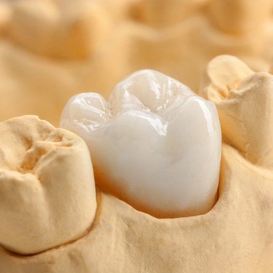 鹿児島市・鹿児島の審美歯科治療（白い詰め物・被せ物）