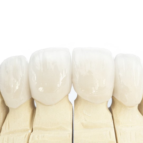 鹿児島市・鹿児島の審美歯科治療（白い詰め物・被せ物）